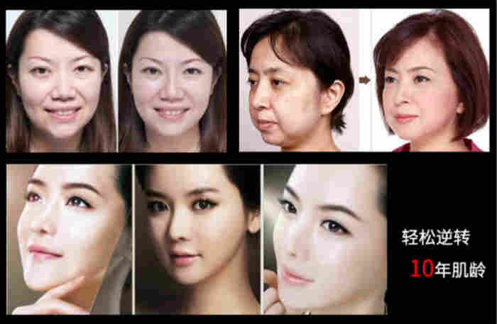 热拉提美容仪效果图