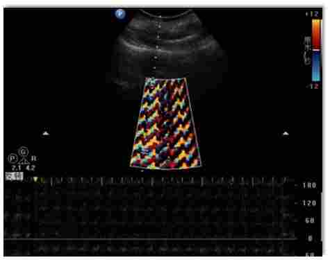 彩超常遇到的干扰故障及排除方法