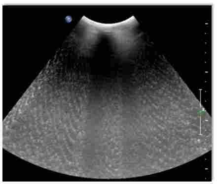 彩超常遇到的干扰故障及排除方法