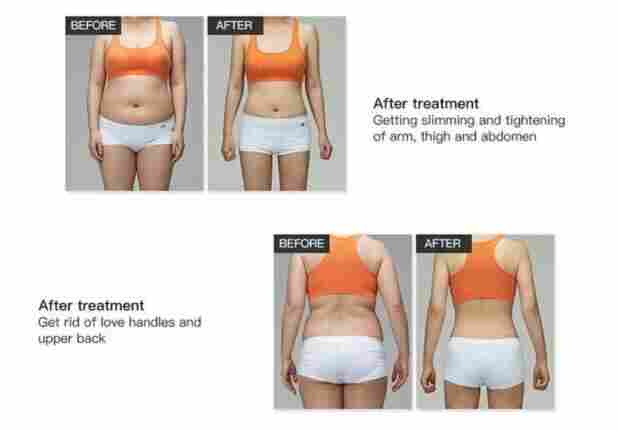 酷塑冷冻减肥仪