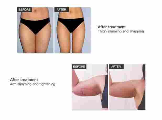 酷塑冷冻减肥仪