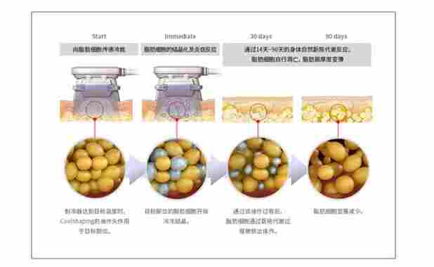 韩国进口EunSung冷冻减肥减脂美容仪器
