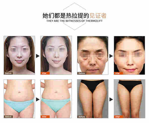 热拉提仪器作用松弛组织，提拉紧肤，唤醒皮肤弹性