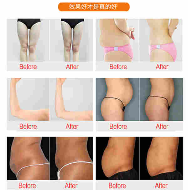 极立瘦仪器管理人体脂肪紧致塑形美体